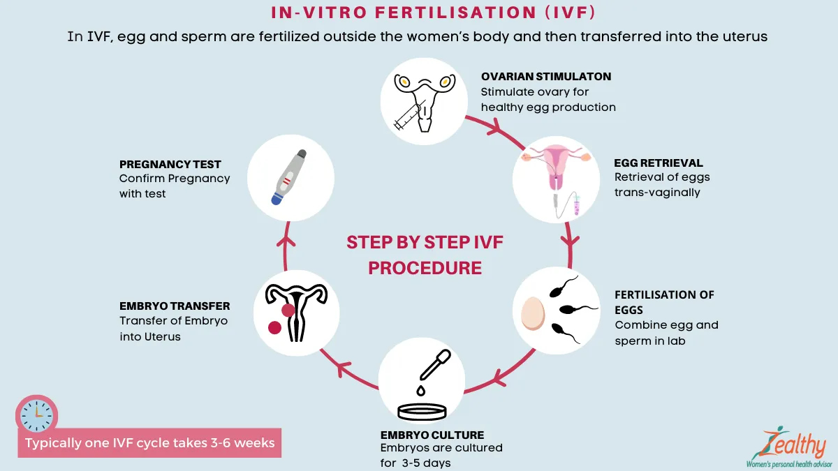 體外受精(IVF)流程示意圖